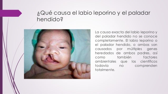 causas de labio leporino y paladar hendido